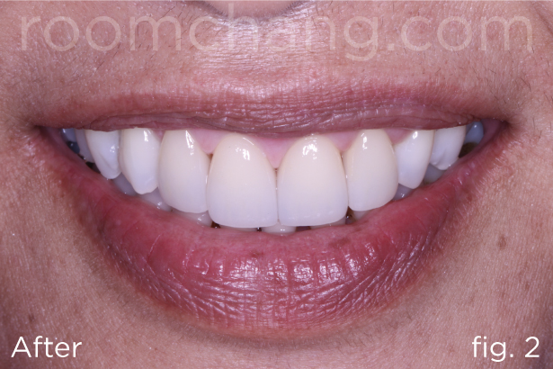 After treatment — four E-Max crowns cemented