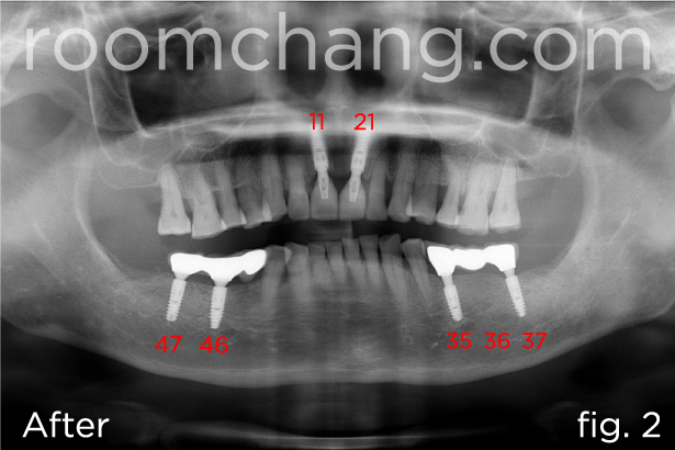 Implant placement — upper and lower arch