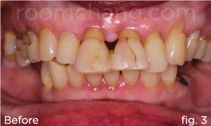 After treatment — final bridge seated