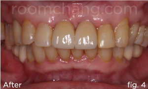 Final result — natural smile restored