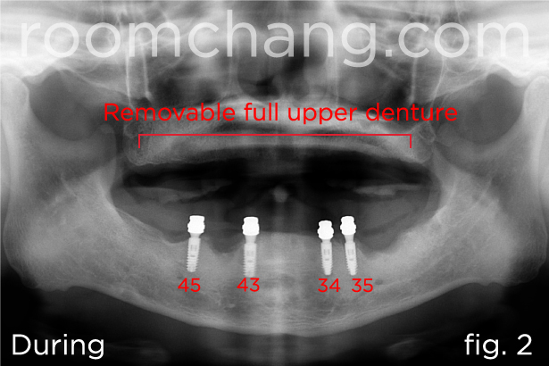 After treatment — Ankylos implant-supported bridge