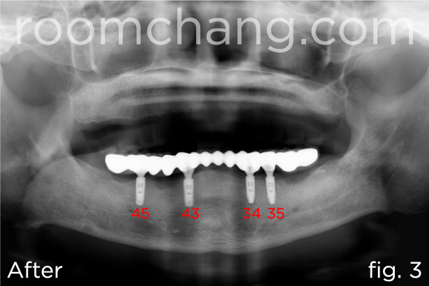 Lower arch — implant positions #34, 35, 43, 45
