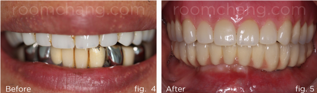 មុន និងក្រោយ — ស្ពាន Implant — ករណី 2