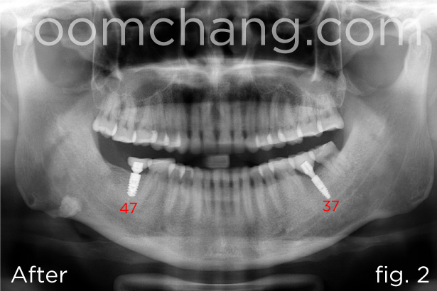 Clinical view — final crown placement