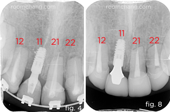 X-ray — after treatment