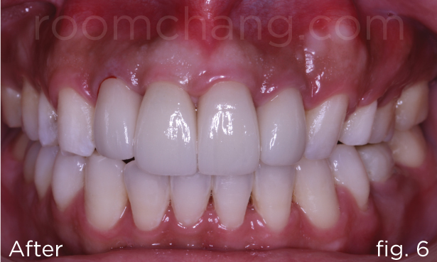 After treatment — open bite corrected