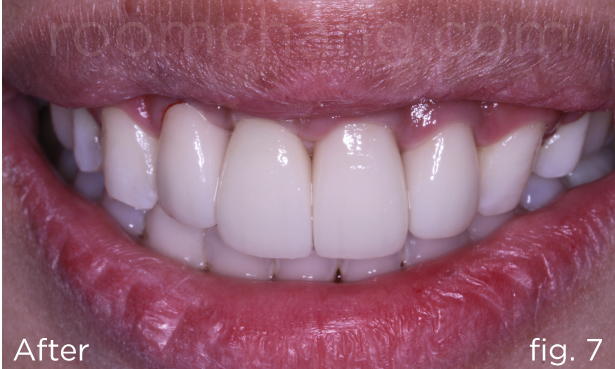 Final result — profile and bite fully restored