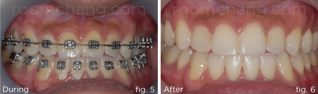 Dental alignment — after bilateral crossbite correction