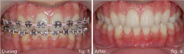 After treatment — full alignment achieved over 2.5 years