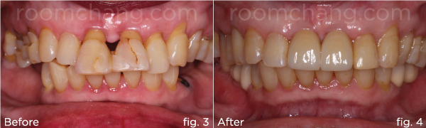 មុន និងក្រោយ — ស្ពាន Implant — ករណី 1