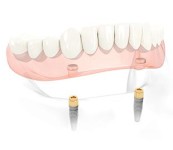 Implant-Supported Dentures in Detail — photo 3