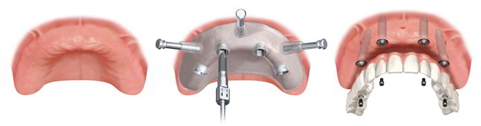 Implant-Supported Dentures in Detail — photo 1