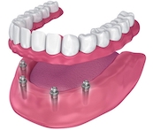 Implant-Supported Dentures in Detail — photo 2