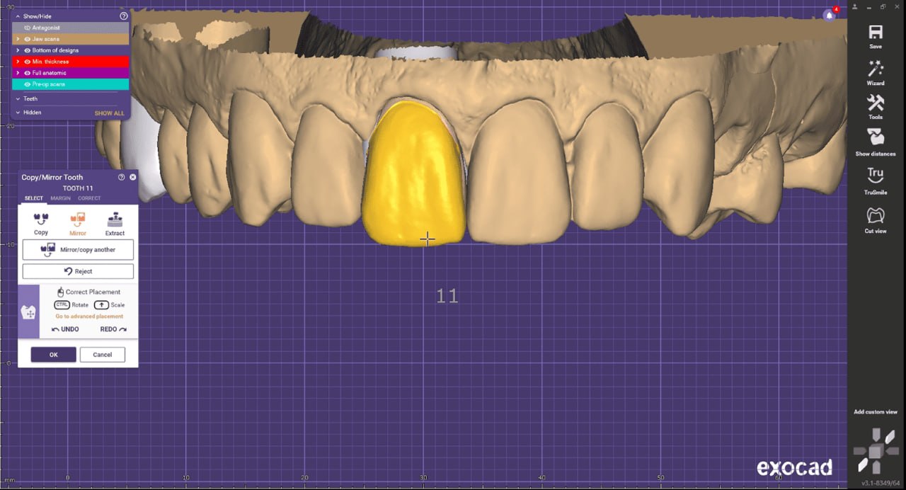 កម្មវិធី CAD សម្រាប់ធ្មេញ Exocad បង្ហាញការរចនាមួកធ្មេញឌីជីថលសម្រាប់ការជួសជុលធ្មេញ